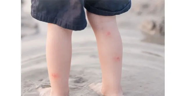 photo les 10 bobos de l'été : les piqûres en tout genre 