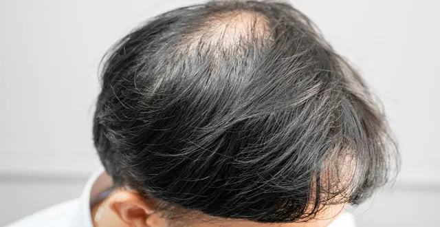 photo  en 2015, l’ifop estimait que 25 % des hommes français étaient atteints de calvitie, contre 2 % de femmes.  &copy;  photo d’illustration : chormail / envato 