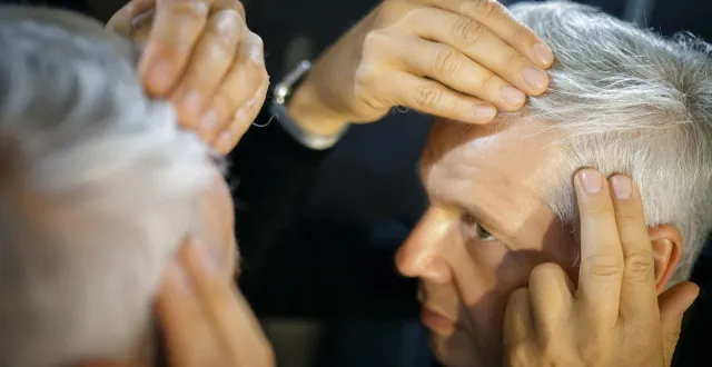 photo  la perte de cheveux cristallise une véritable « panique », observe le dr philippe assouly.  &copy;  dpa picture-alliance via afp 