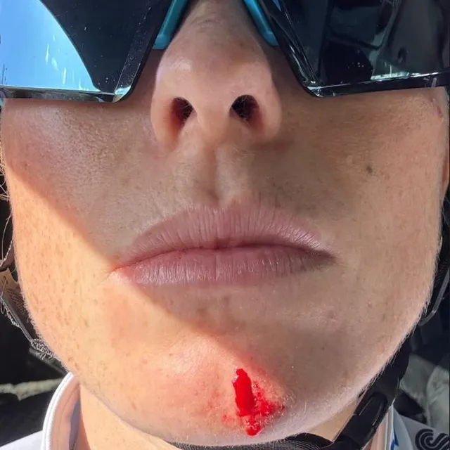 photo le visage de demi vollering après sa chute à l’entraînement.  ©  capture d’écran demi vollering instagram